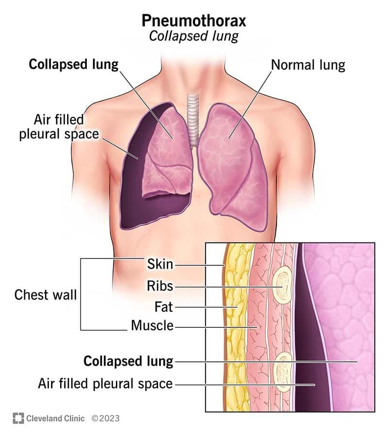 Pneumothorax Classification gallery image